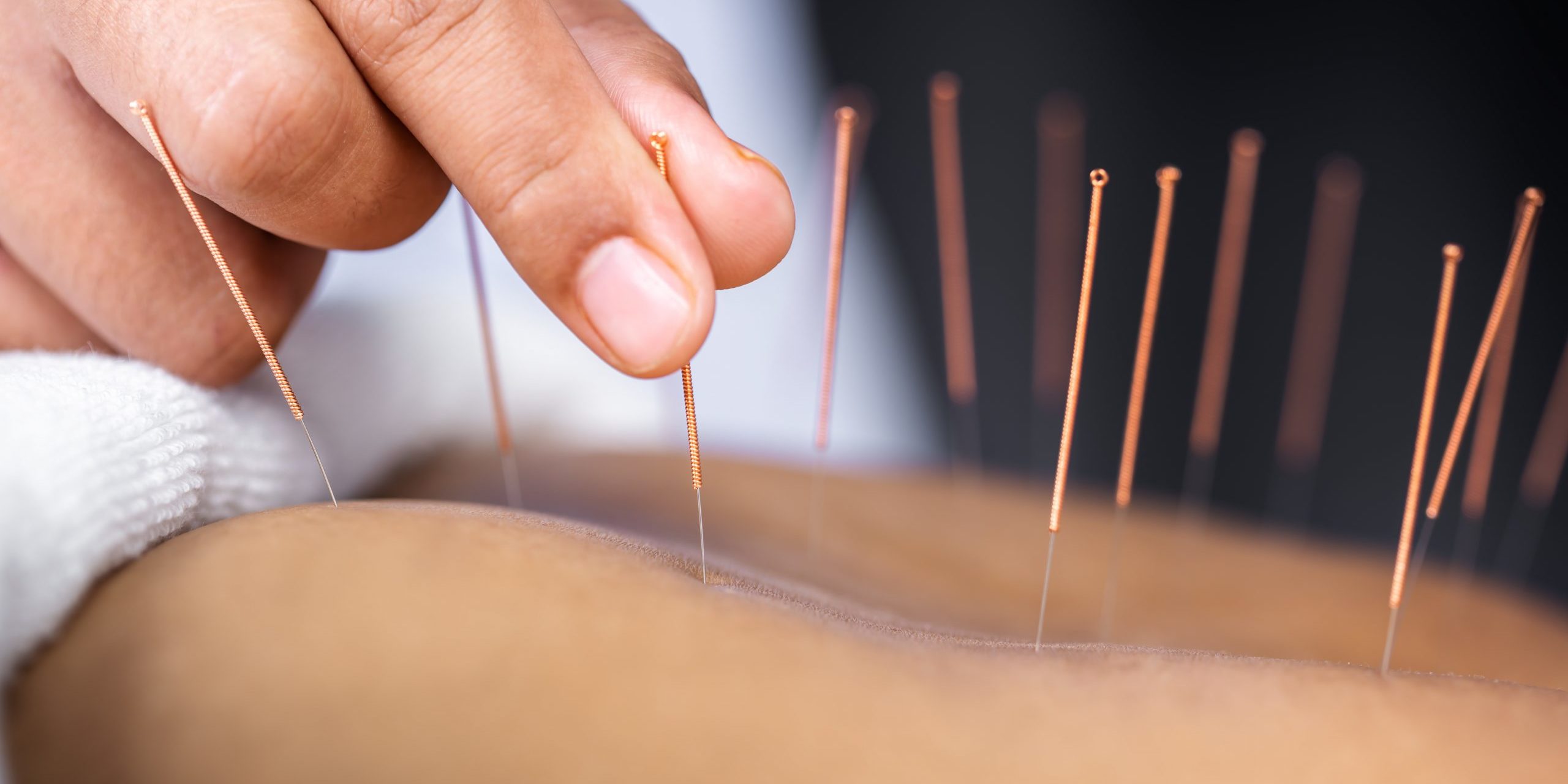 Image of acupuncture therapy with needles inserted at key acupoints, illustrating the healing process and benefits for pain relief and wellness.